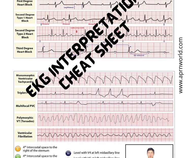 Printable 12 Lead Ekg Interpretation Cheat Sheet Free Printable Templates