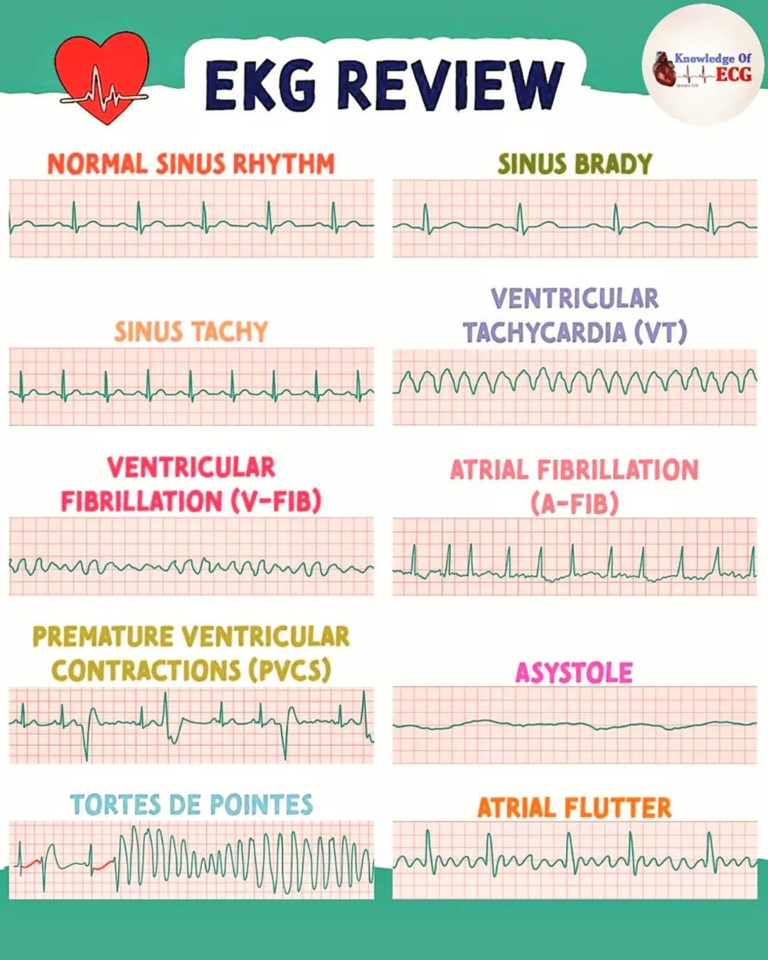 Printable Ekg Interpretation Cheat Sheet Bilarasa