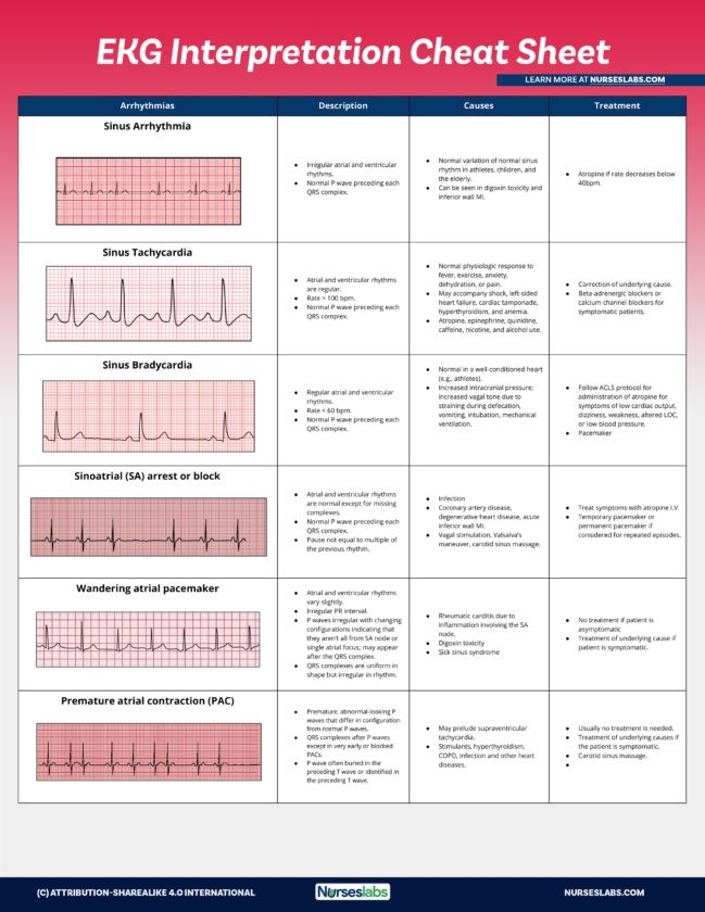 Printable Ekg Interpretation Cheat Sheet The Best Porn Website